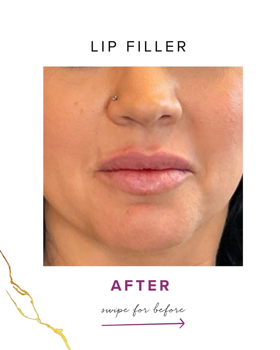Instagram post by Dr. Melinda Menezes: Lip filler can be a beautiful option for soft, full, hydrated-looking lips when administered by a skilled, experienced provider. It’s import…