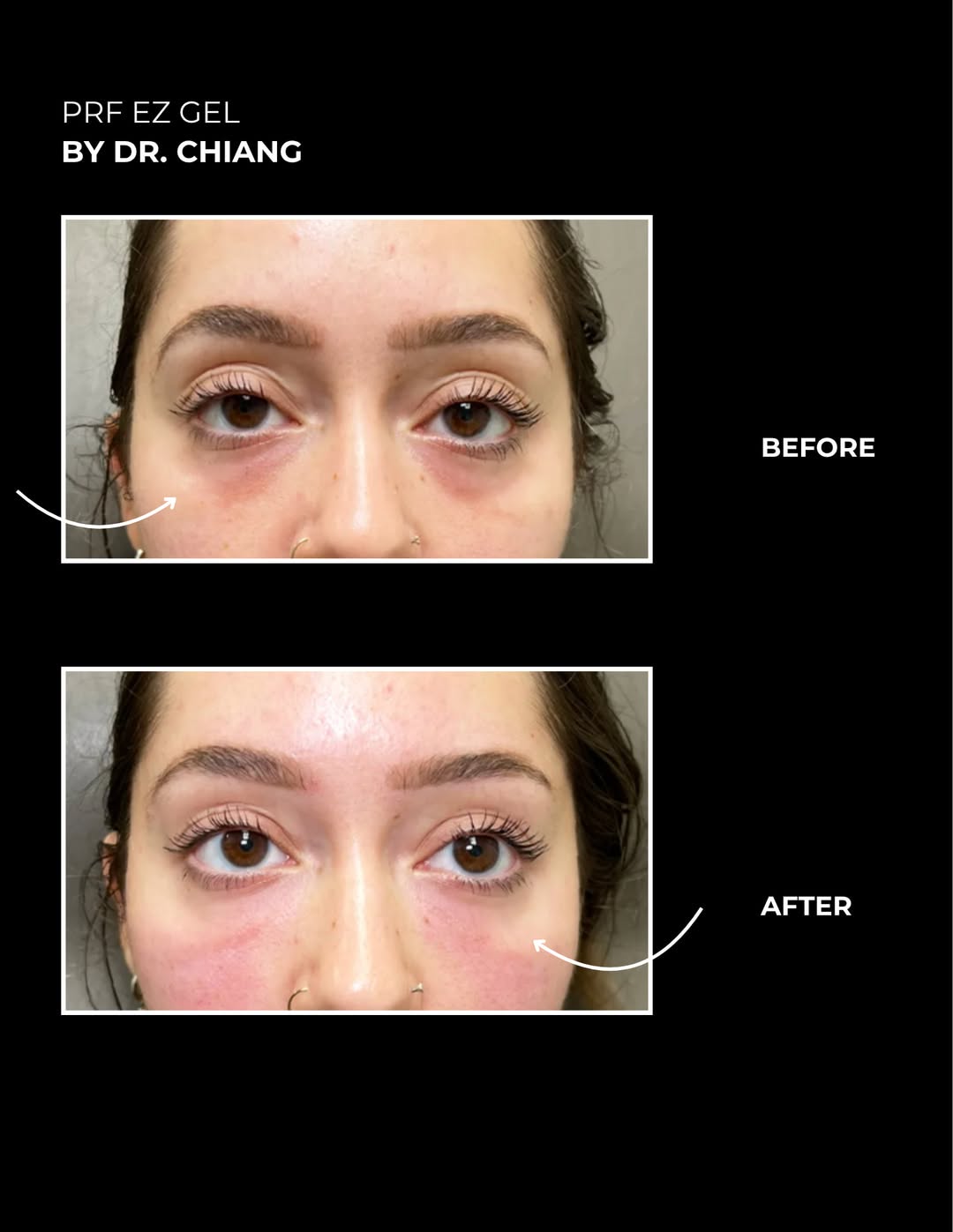 Instagram post by Dr. Melissa Chiang: PRF EZ Gel can help refresh the under-eye area by using your body’s own healing properties to improve volume, texture, and overall skin qual…