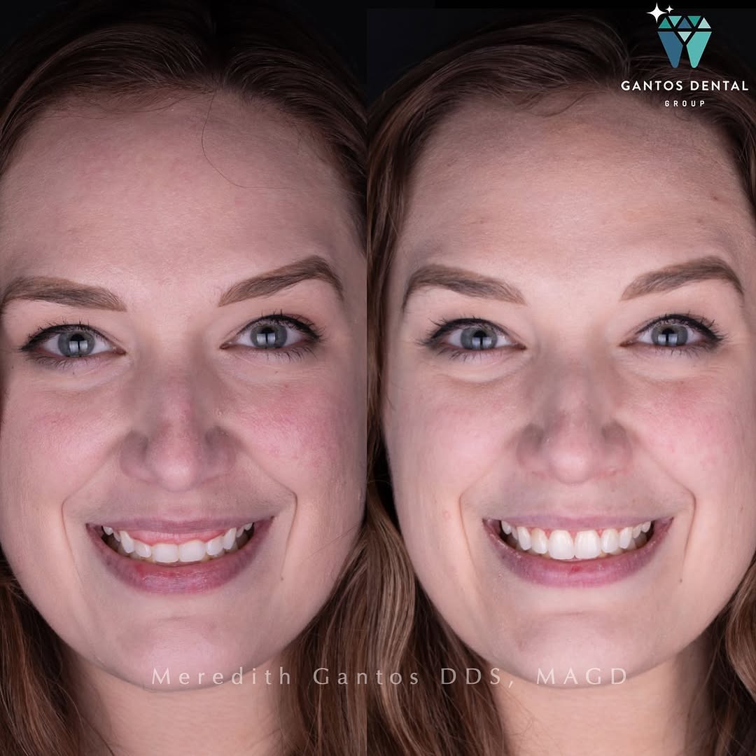 Instagram post by Dr. Meredith Gantos, DDS, MAGD, MaCSD: A permanent gum lift for this gorgeous chica 😍 What can you accomplish with a more confident smile? To talk to a cosmetic dentist about you…