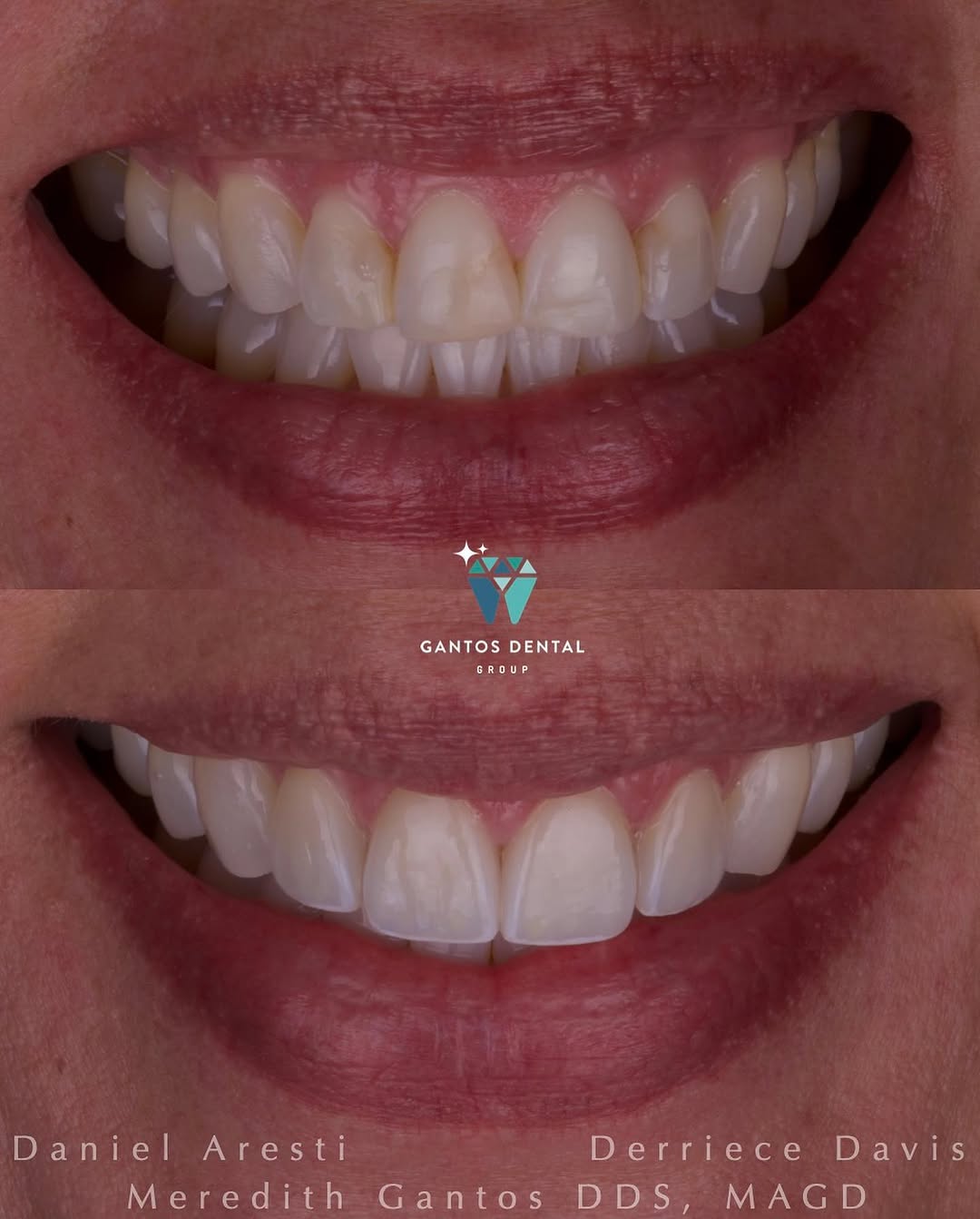 Instagram post by Dr. Meredith Gantos, DDS, MAGD, MaCSD: Smile Perfection ✨ 1️⃣ Clear aligner therapy (before photo after completion of treatment) 2️⃣ Bleaching 3️⃣ Four custom porcelain veneers An…