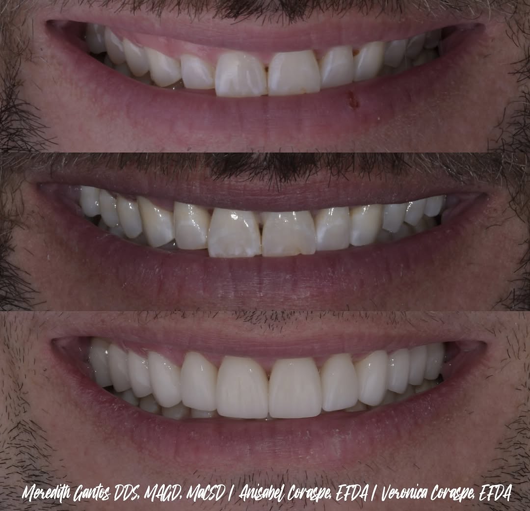 Instagram post by Dr. Meredith Gantos, DDS, MAGD, MaCSD: Check out this beautiful smile transformation! We addressed the pink esthetics first to camouflage a skeletal cant and create greater symmet…