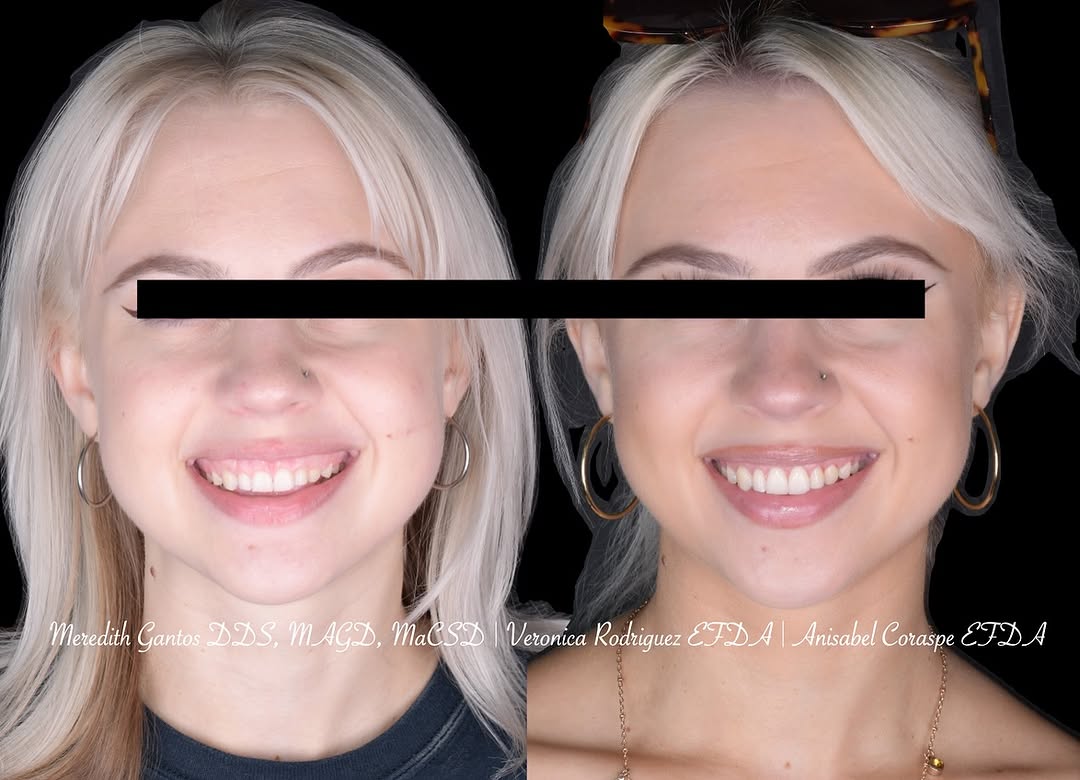 Instagram post by Dr. Meredith Gantos, DDS, MAGD, MaCSD: SMILE CONFIDENCE She was gorgeous before and after- but the glow she exudes with her increased confidence is incredible! 🦷 Procedure: Perma…