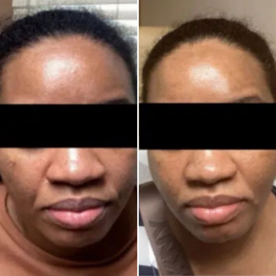 Instagram post by Dr. Meryl Blecker Joerg: This before & after by Shira Ehrlich, MPAS, RPA-C, shows what strategic collagen stimulation can do for overall skin quality: smoother textu…