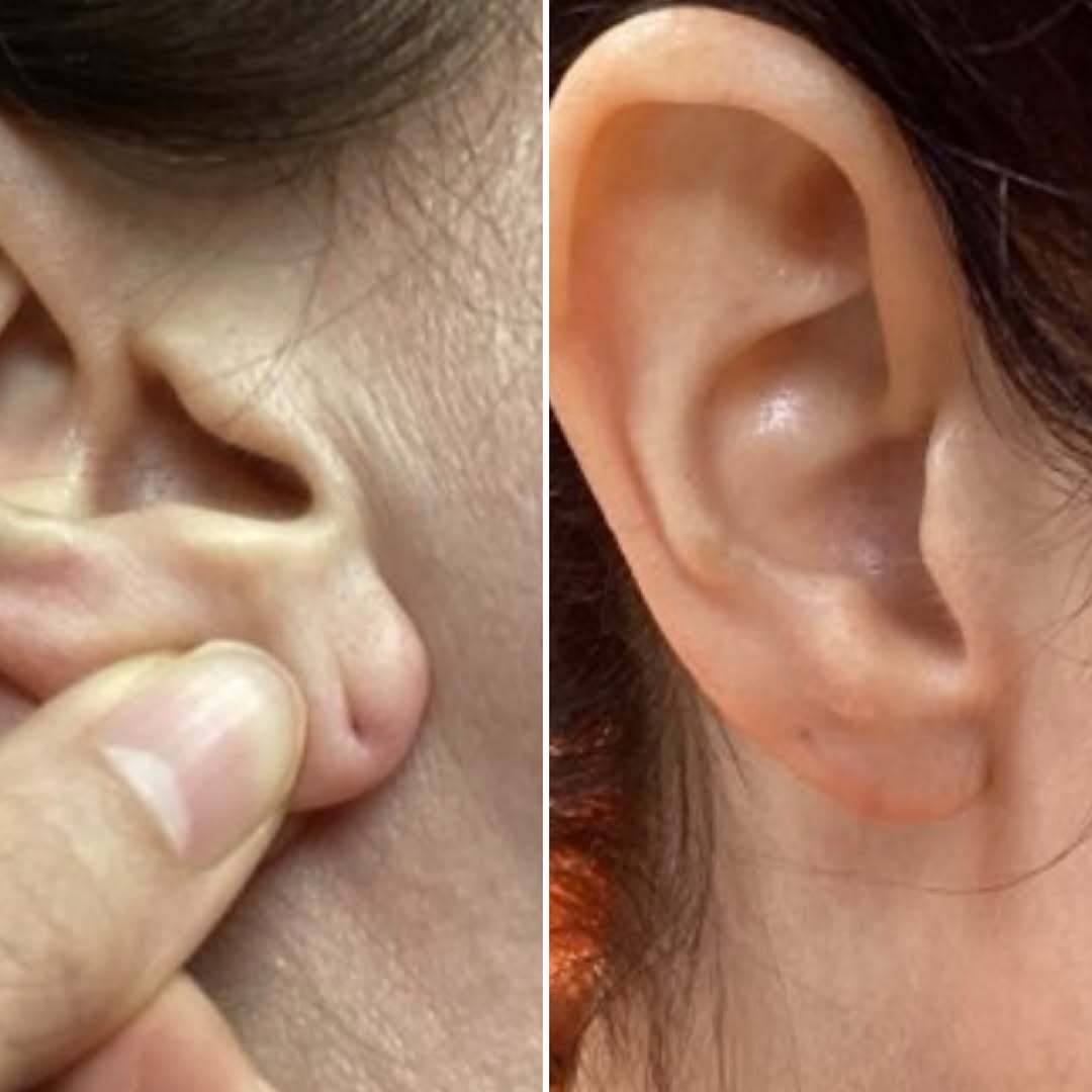 Instagram post by Dr. Meryl Blecker Joerg: A beautifully restored earlobe following a quick and convenient office visit! Earlobe repair can help restore the shape and appearance of ea…
