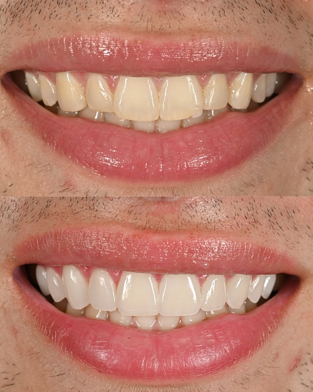 Instagram post by Dr. Michael A. Apa: Super-thin veneers for a new smile. Swipe to see the videos. This is just one day post-op.