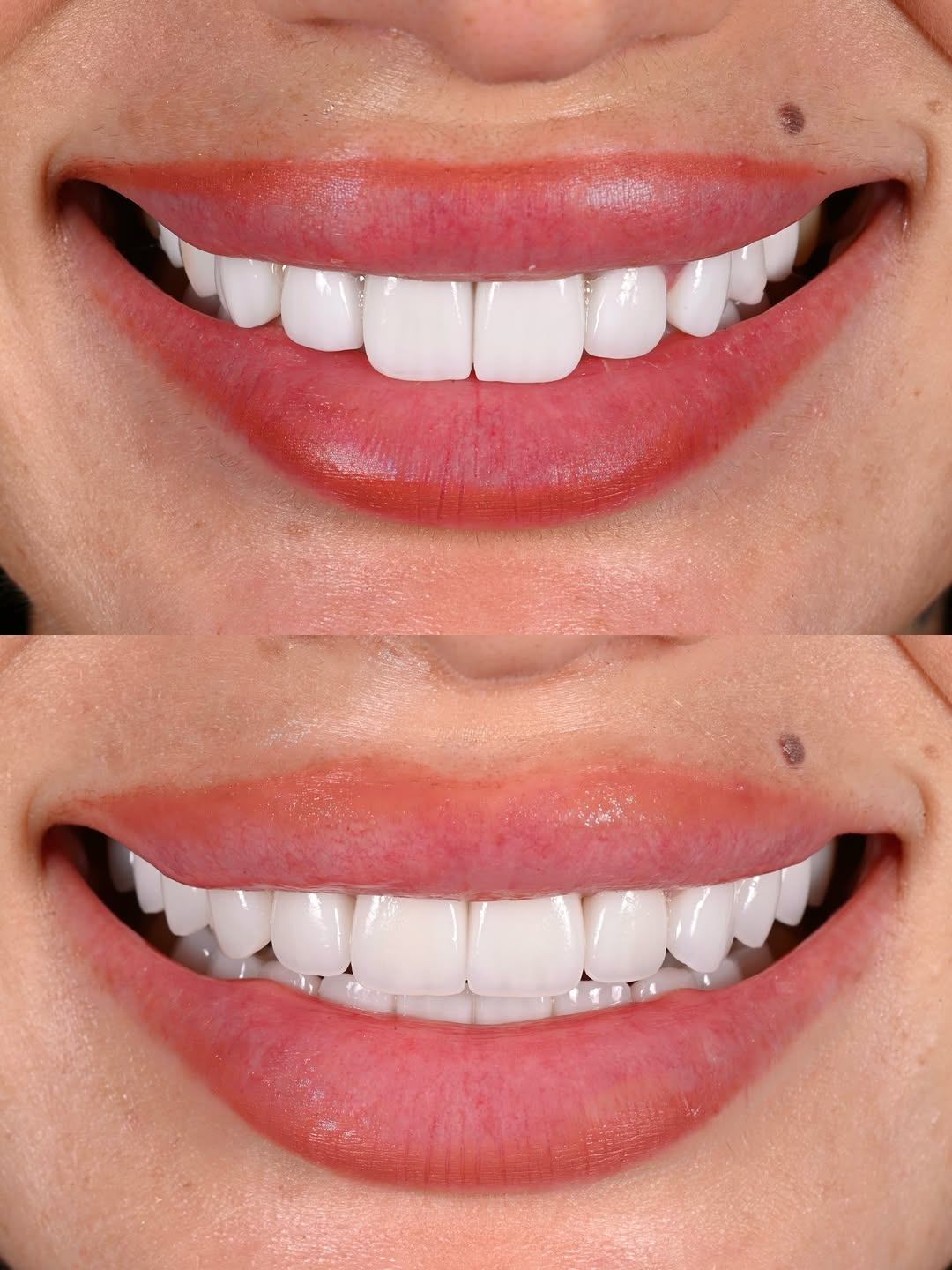 Instagram post by Dr. Michael A. Apa: Its important to remember that not every approach is the same, not every dentist is the same and definitely the same smile can look very dif…