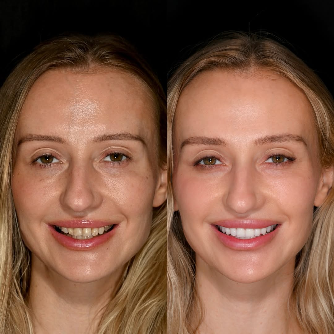 Instagram post by Dr. Michael A. Apa: The perfect smile for someone, whether they’re lucky enough to be born with it naturally or chose to achieve it through a smile makeover, is…