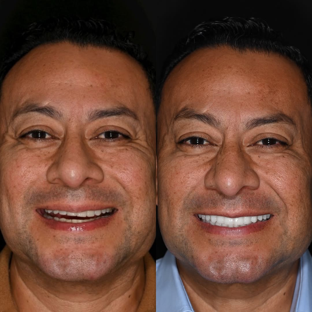 Instagram post by Dr. Michael A. Apa: Sometimes creating balance means embracing asymmetry. This patient presented with a canted maxilla, flared existing veneers, and a midline t…