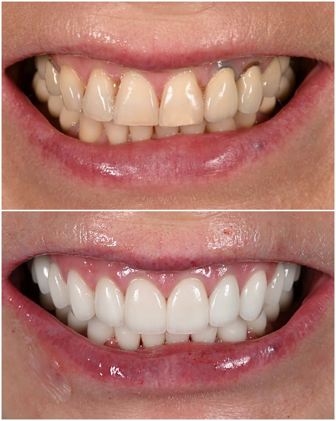 Instagram post by Dr. Michael A. Apa: A full mouth rehabilitation and the biggest goal here wasn’t just giving her a beautiful smile. It was rebuilding the foundation underneath …