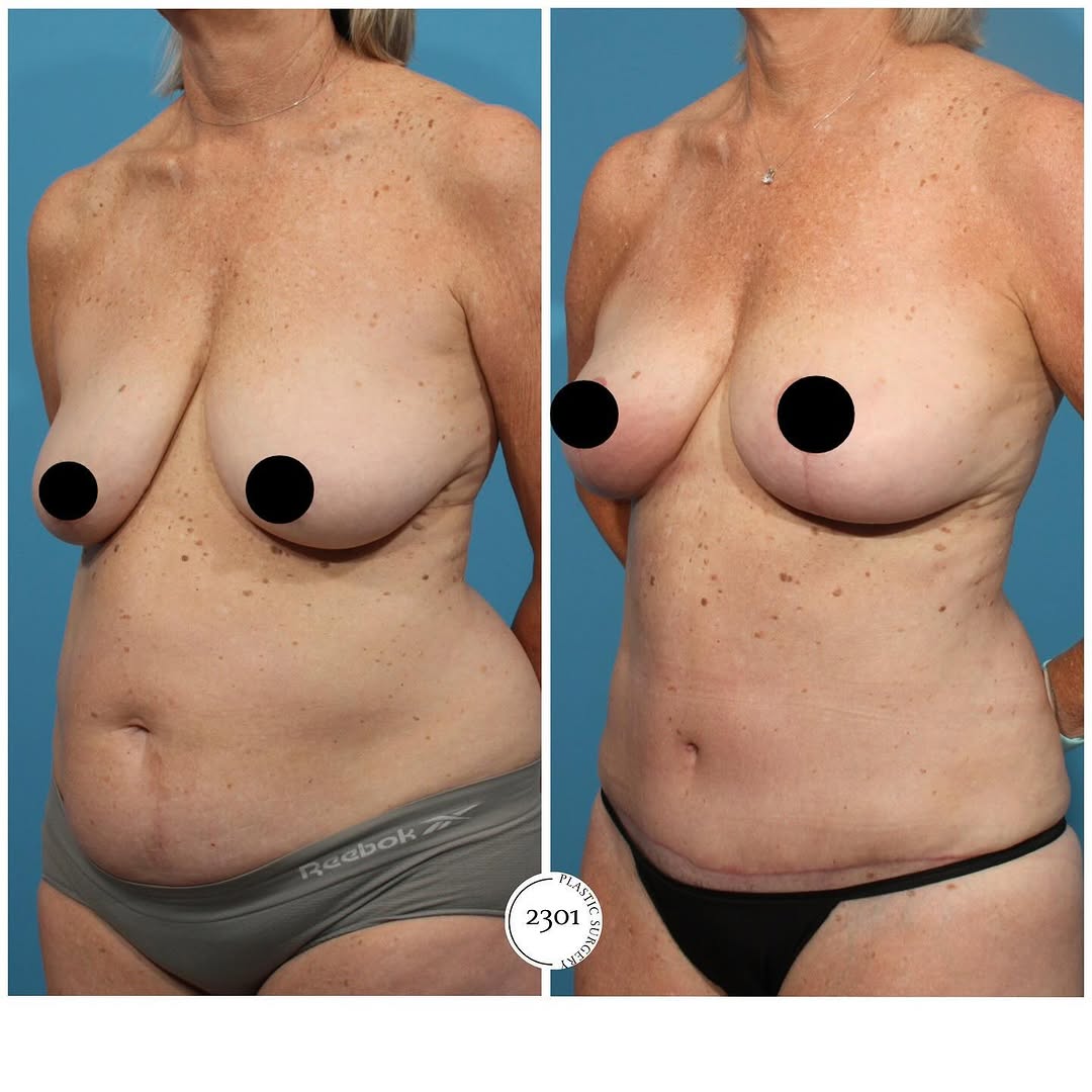 Instagram post by Dr. Michael A. Bogdan: Transforming confidence, one procedure at a time! 🌟 Check out this stunning before and after of a Tummy tuck, Breast lift, and Liposuction.…