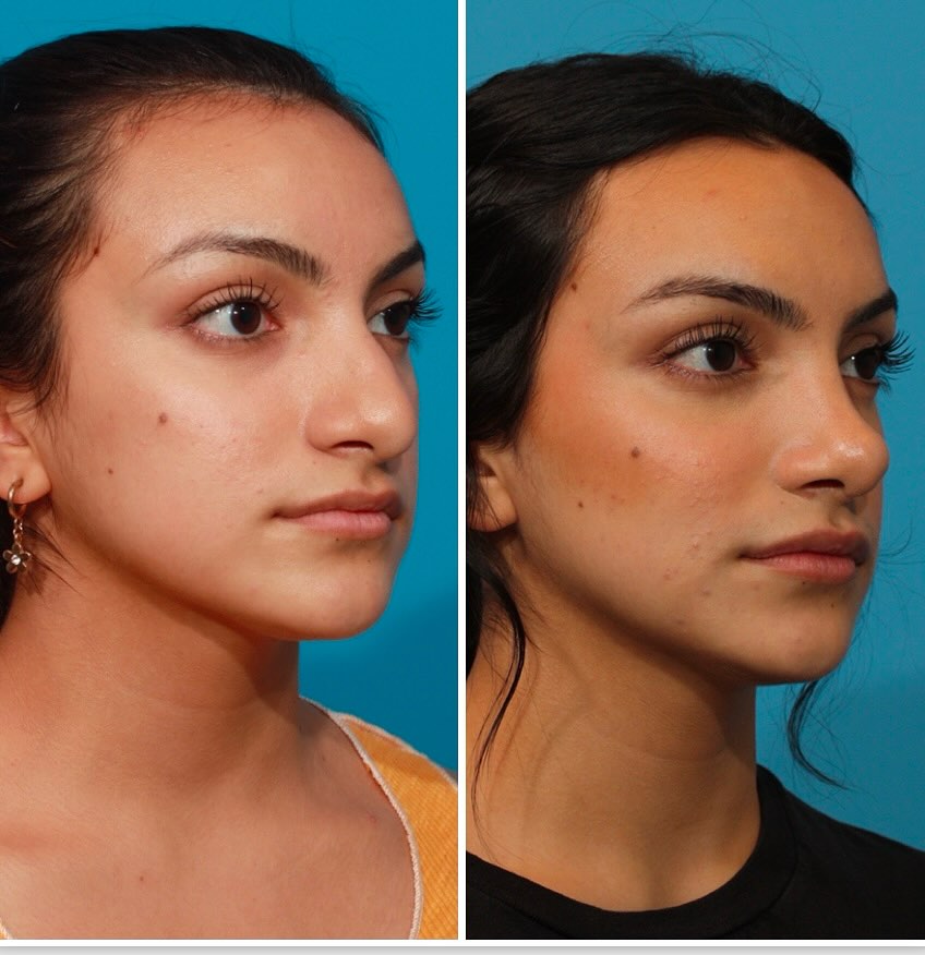 Instagram post by Dr. Michael A. Bogdan: Check out this stunning before and after of our patient’s rhinoplasty! She’s absolutely loving her results. The procedure beautifully refine…