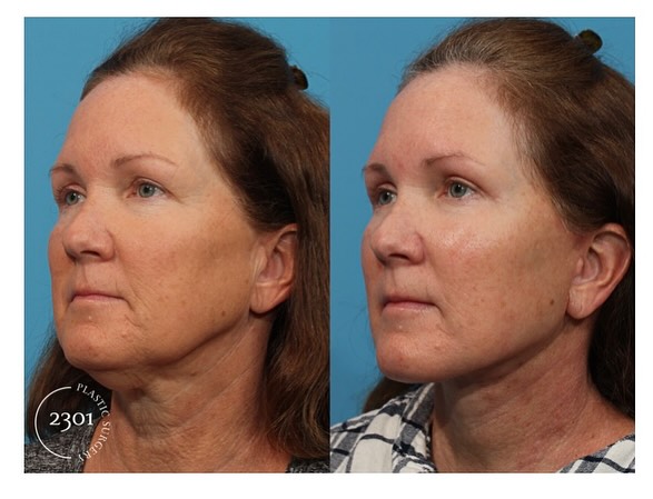 Instagram post by Dr. Michael A. Bogdan: ✨ Our patient is glowing with confidence after her upper Blepharoplasty, and Face / Neck lift. The results speak for themselves – a more you…