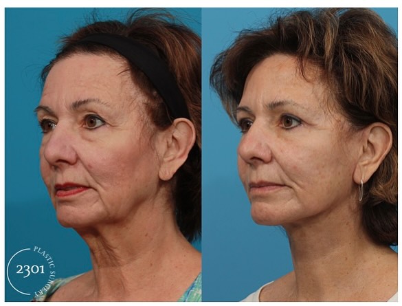Instagram post by Dr. Michael A. Bogdan: ✨ A face and neck lift combined with upper and lower blepharoplasty has brought out her natural radiance. She’s absolutely in love with the …