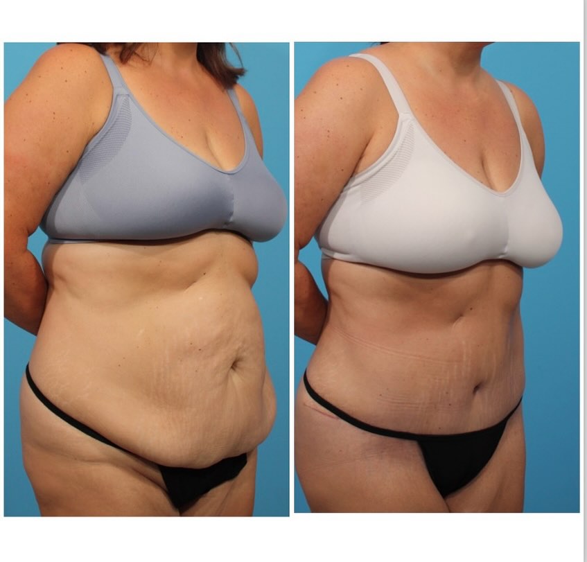 Instagram post by Dr. Michael A. Bogdan: This patient achieved beautiful results following abdominoplasty and liposuction performed by Dr. Bogdan. She’s thrilled with her transforma…