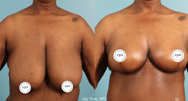 Instagram post by Dr. Michael A. Bogdan: Significant weight loss can change the shape, size, and position of the breasts. For the right candidate, a breast reduction can restore bot…