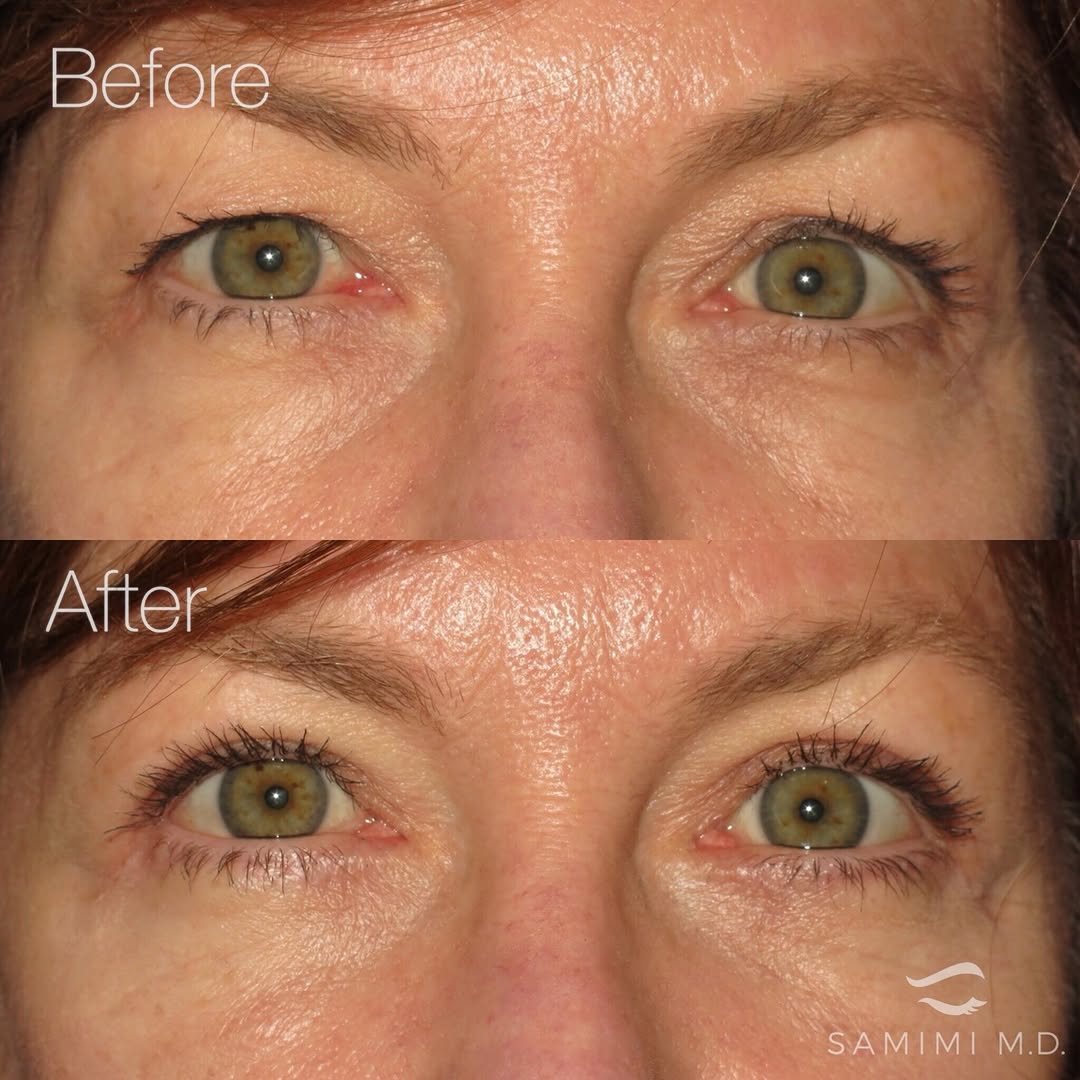 Instagram post by Dr. Michael A. Burnstine: Excellent results for this patient following my signature Health Blink™ Blepharoplasty, designed to restore volume and achieve a refreshed, …