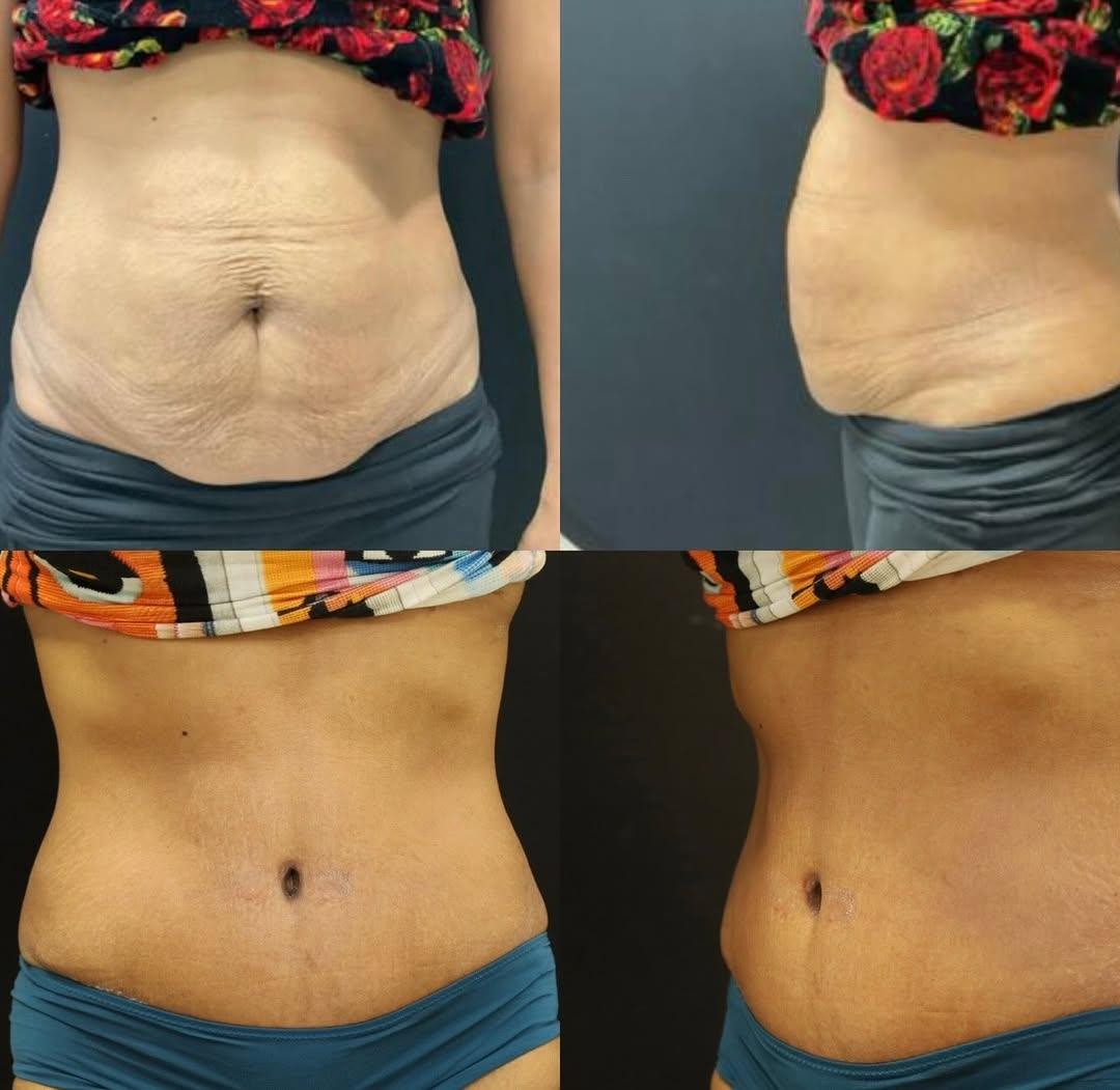 Instagram post by Dr. Michael A. Fiorillo: Tummy tuck transformation Loose skin, laxity and abdominal changes → a flatter, tighter, more defined abdomen. The goal isn’t to change who …