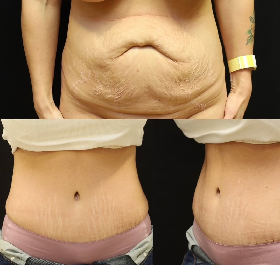 Instagram post by Dr. Michael A. Fiorillo: A transformation that speaks for itself Tummy tuck to remove excess skin, repair and tighten the abdominal wall, and restore a flatter, more…