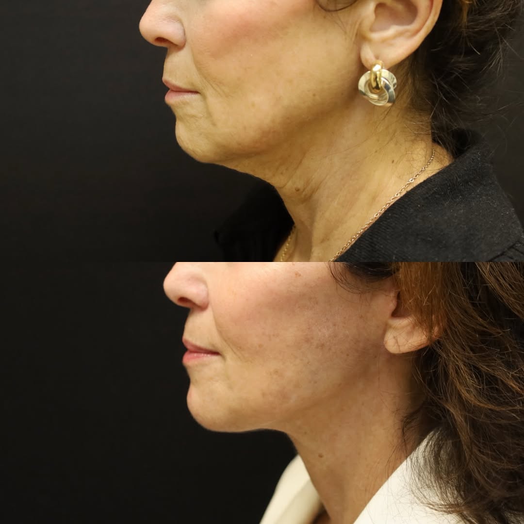 Instagram post by Dr. Michael A. Fiorillo: Facelift & neck lift - 1 year out A cleaner jawline, smoother neck, and natural rejuvenation—without looking overdone. Refreshed. Refined. S…