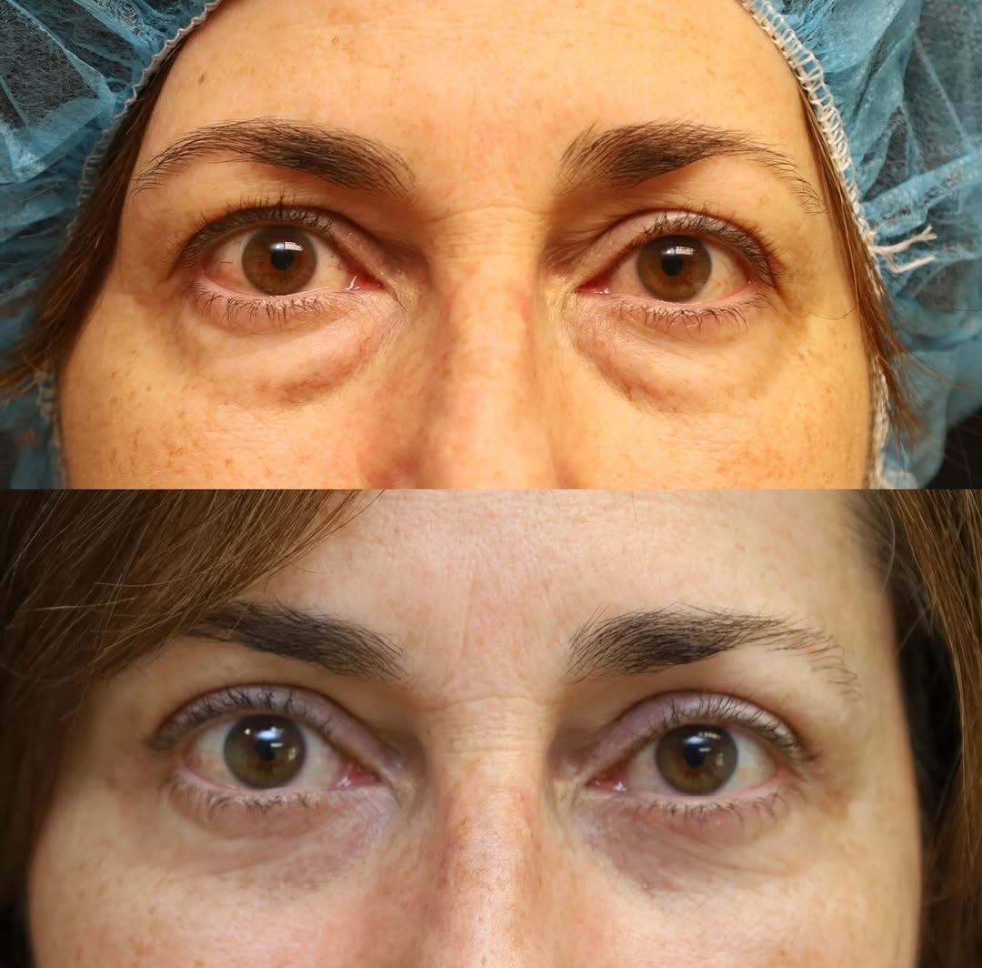 Instagram post by Dr. Michael A. Fiorillo: Upper and lower blepharoplasty Brighter eyes. Smoother contours. Still completely natural.