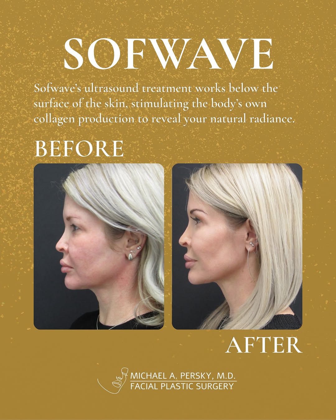 Instagram post by Dr. Michael A. Persky: No needles. No recovery week. Sofwave sends ultrasound energy into the skin without breaking the surface. Your body responds by building new…