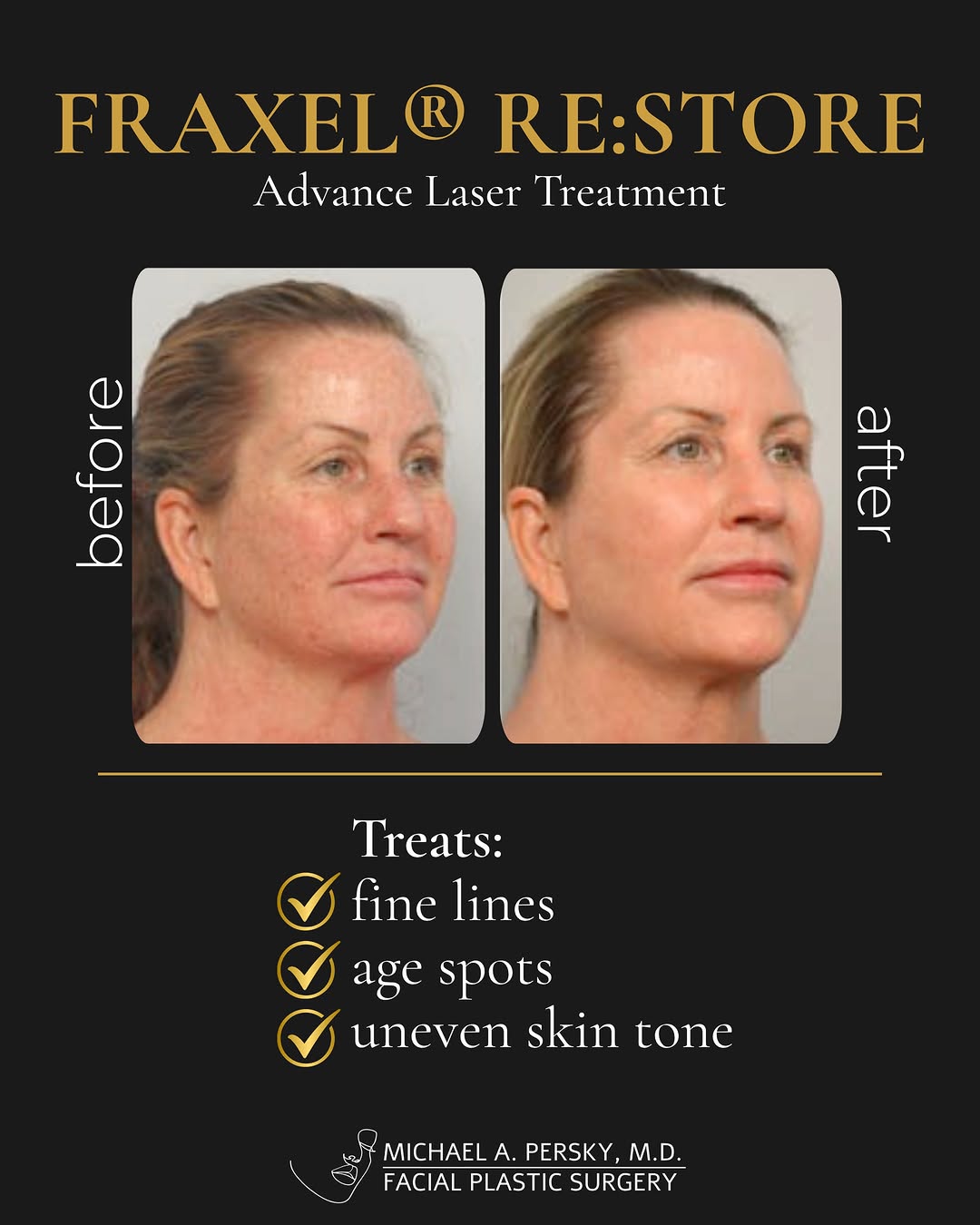 Fraxel isn't one treatment. It's three, and Dr. Persky picks the right one for your skin.
A patient of Dr. Michael Persky before and after picture after having undergone an advance laser treatment of