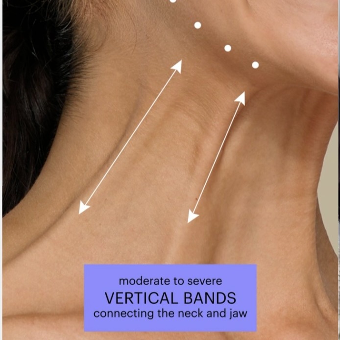 Instagram post by Dr. Michael B. Lyons: DO YOU HAVE PLATYSMA BANDS???? BOTOX CAN HELP WITH THAT!!! GIVE US A CALL AT 251-344-0044 IF YOU ARE NEW TO BOTOX YOU CAN RECEIVE UP TO $65.…