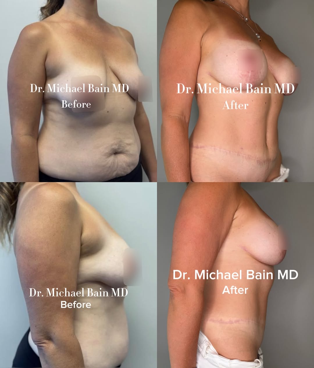 Instagram post by Dr. Michael Bain: This patient underwent a customized Mommy Makeover combining a mastopexy (breast lift) with implants and abdominoplasty (tummy tuck) to rest…