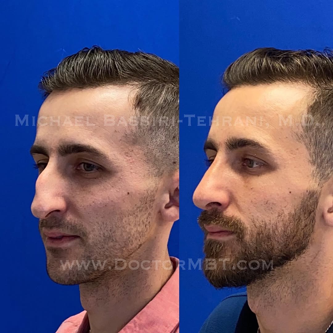 Instagram post by Dr. Michael Bassiri-Tehrani: Let's just say this patient prefers straight runs over moguls ⛷ Here are long term follow-up photos of a serious functional rhinoplasty. Thi…