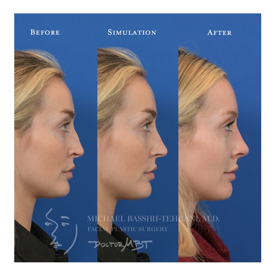 Instagram post by Dr. Michael Bassiri-Tehrani: Manifesting the morph into reality. Previous nasal surgery left this lovely patient with alar retraction, midvault collapse, and an unsuppor…