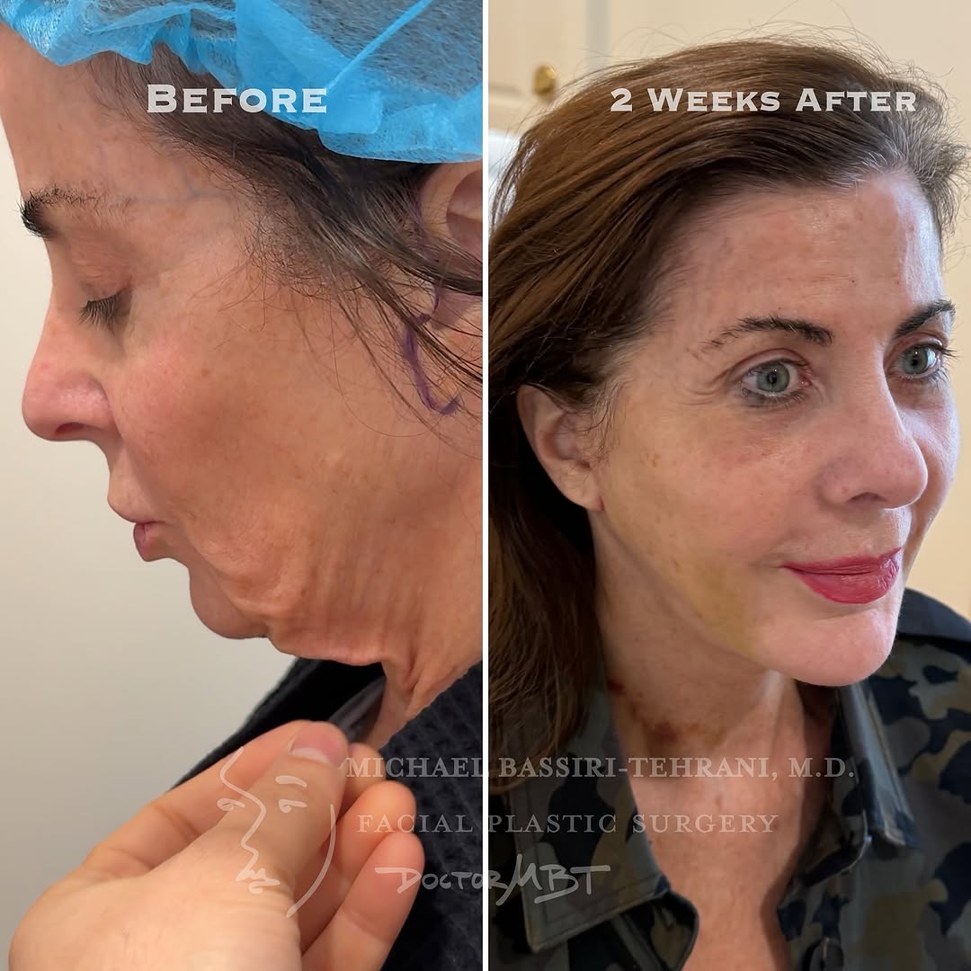 Instagram post by Dr. Michael Bassiri-Tehrani: This upbeat patient is two weeks post op from an endoscopic midface lift plus revision facelift surgery. She was bothered by the accumulatin…