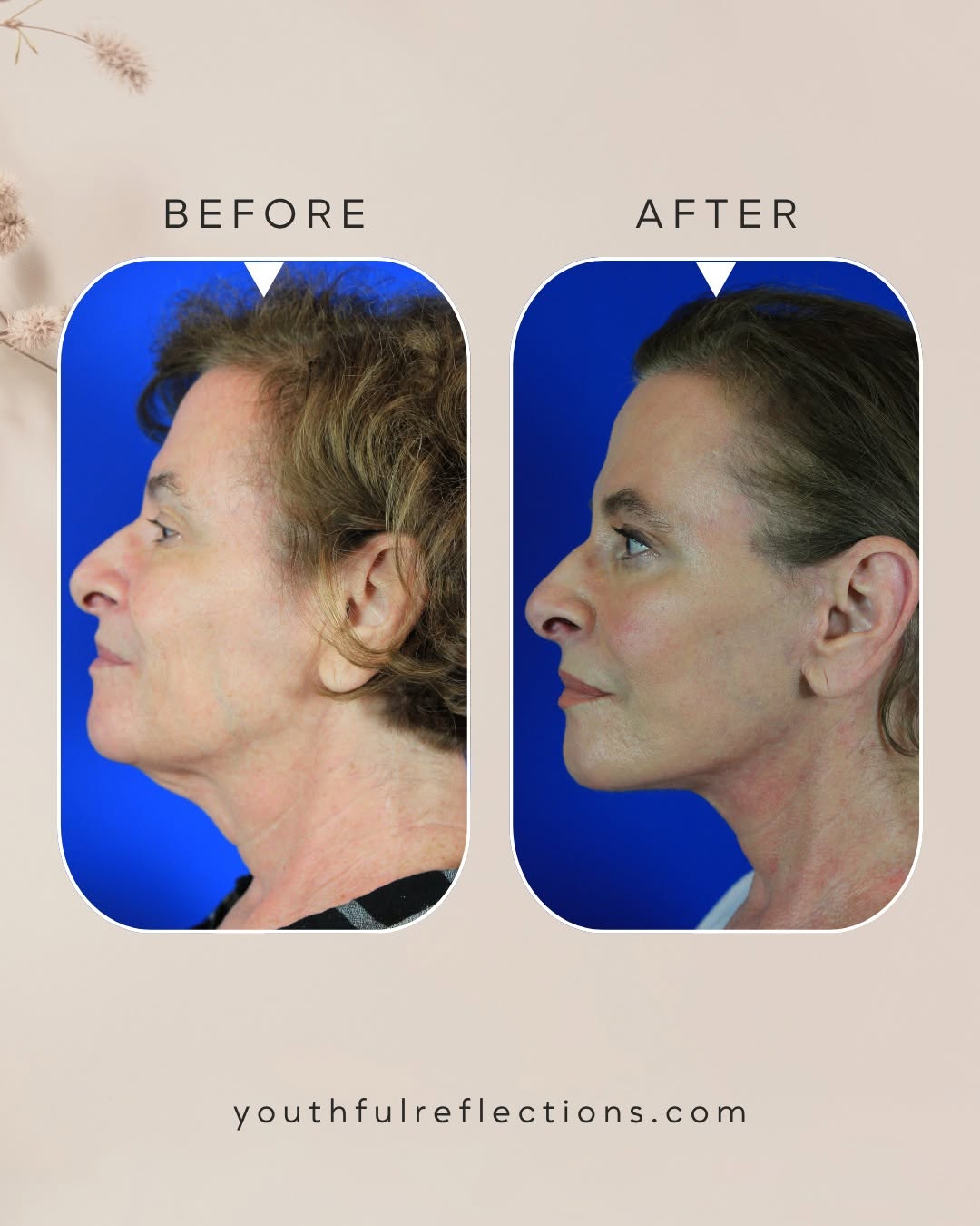 Instagram post by Dr. Michael Boggess: Looking refreshed doesn't have to mean looking different. The Reflection Lift is designed to restore youthful definition to the face and nec…