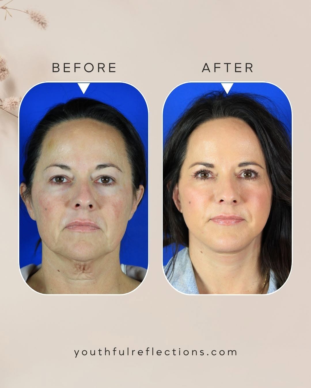 Instagram post by Dr. Michael Boggess: This treatment plan combined a Reflection Lift, upper blepharoplasty, and facial fat transfer to create a refreshed, balanced result while p…