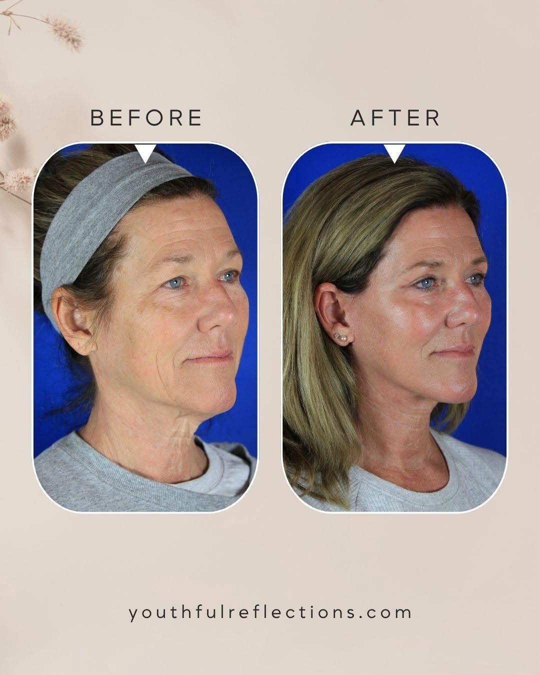 Instagram post by Dr. Michael Boggess: Thoughtful changes can make a meaningful difference! This patient’s personalized treatment plan combined a Reflection Lift, upper blepharopl…