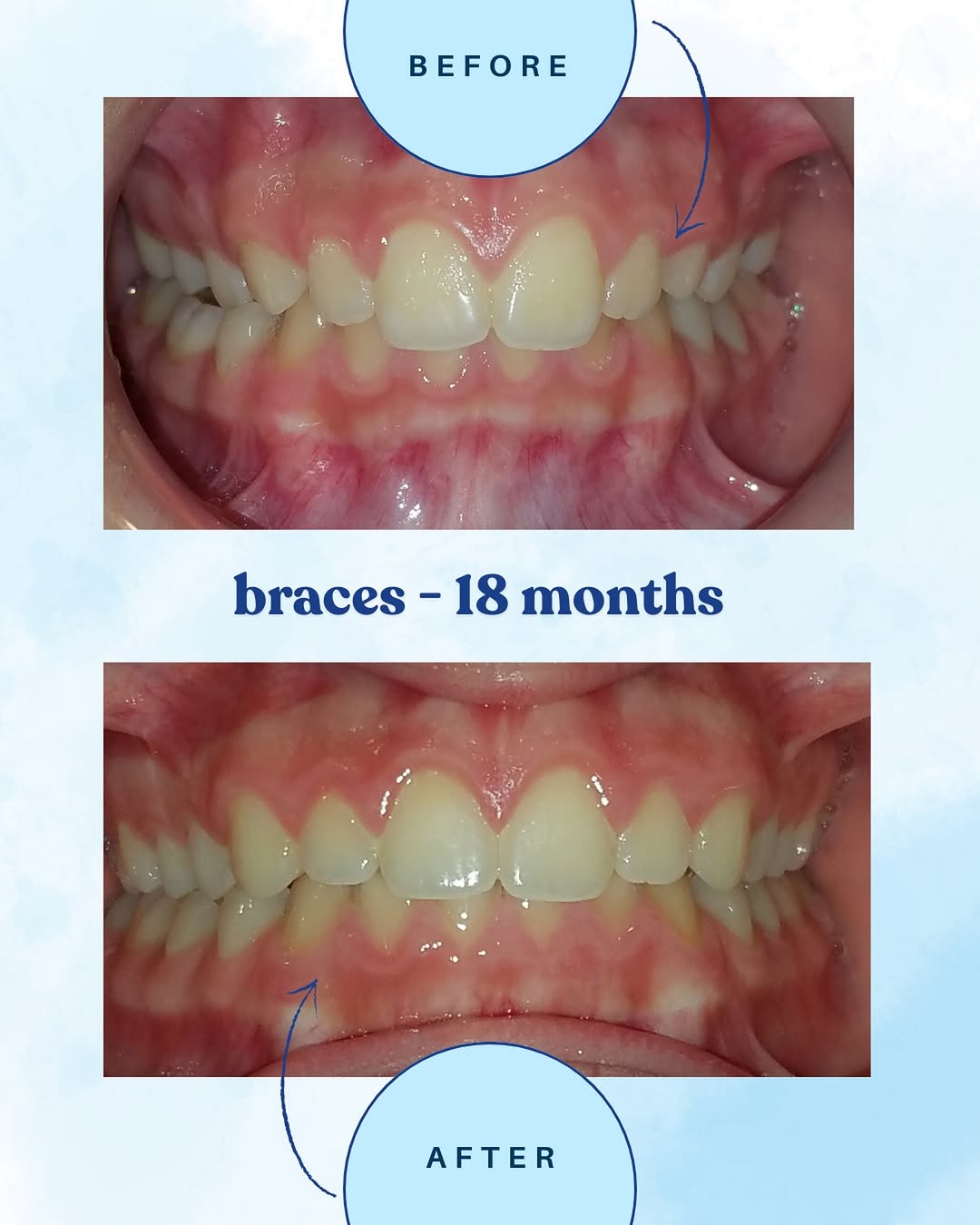 Instagram post by Dr. Michael Clemente, D: ✨ Transformation Tuesday! ✨ 18 months of braces and the results speak for themselves! 😁🦷 From where we started to where we are today, this…
