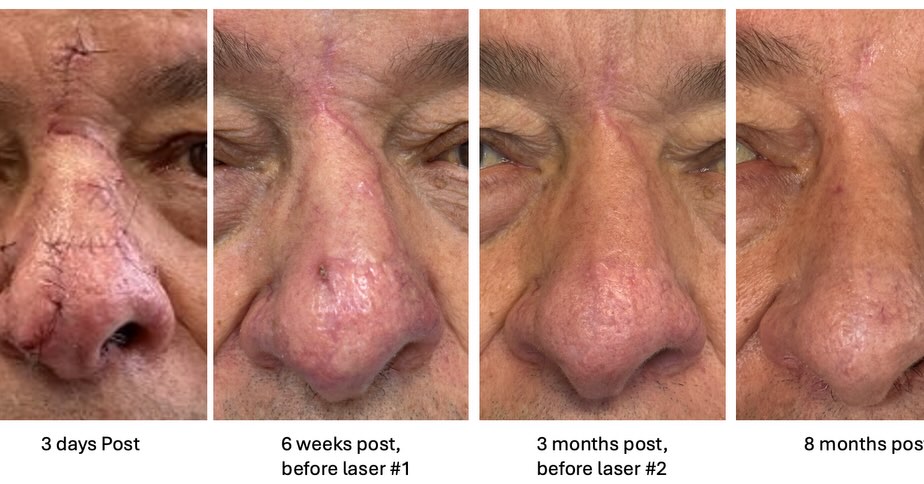 Instagram post by Dr. Michael Contreras: ✨ Exceptional Surgery. Exceptional Healing. ✨ Skin cancer removal—especially on areas like the nose—requires both precision and artistry. 📸…
