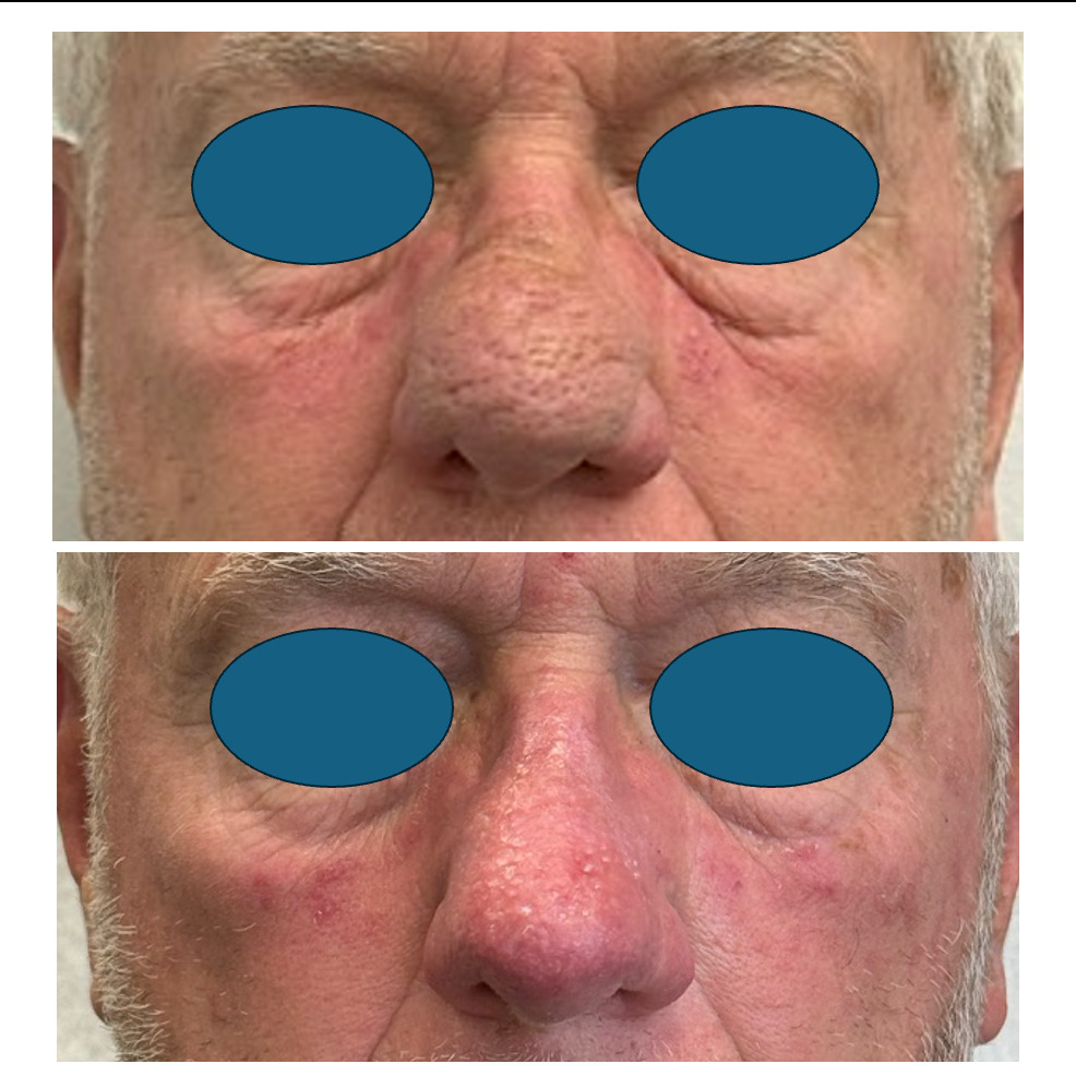 Instagram post by Dr. Michael Contreras: 👃 Restoring More Than a Nose—Restoring Confidence ✨ Rhinophyma is a progressive condition that causes the nose to become enlarged, thickene…
