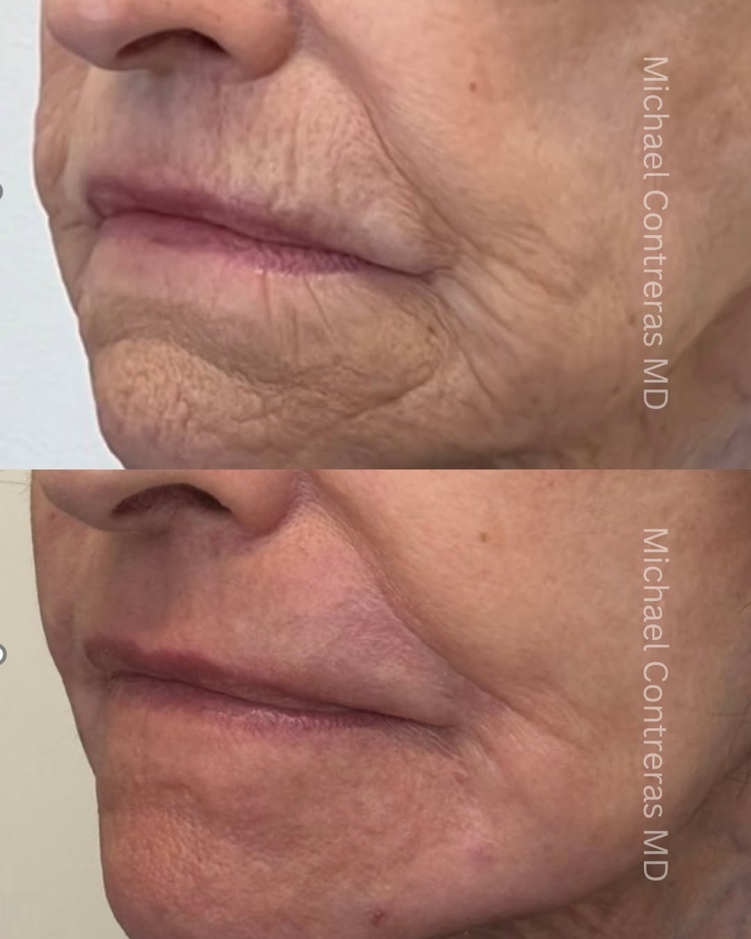Instagram post by Dr. Michael Contreras: ✨ When a Facelift Isn’t the Whole Story... A facelift can do an excellent job restoring facial contours and tightening loose skin, but it do…