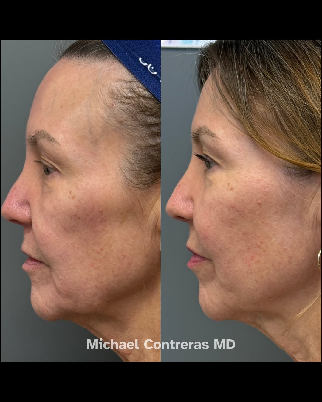 Instagram post by Dr. Michael Contreras: “I don’t feel like I need a facelift anymore." That’s what my patient told me after completing a series of three treatments with Sculptra in…