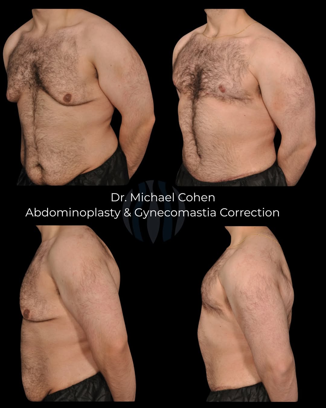 Instagram post by Dr. Michael D. Cohen: Confidence restored. This transformation combines abdominoplasty and gynecomastia correction to create a more sculpted, masculine profile. I…
