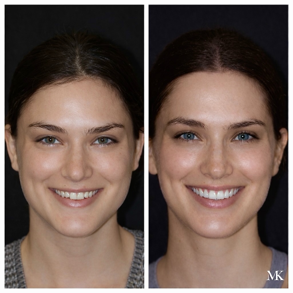 Instagram post by Dr. Michael D. Kosdon: Most people don’t want a new smile. They want their smile — at its best. Natural-looking porcelain veneers designed to fit your face, your f…