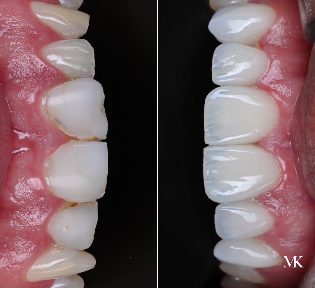 Instagram post by Dr. Michael D. Kosdon: Six hand-layered porcelain veneers were used as a more permanent solution to replace existing bonding that was beginning to break down. Beyo…
