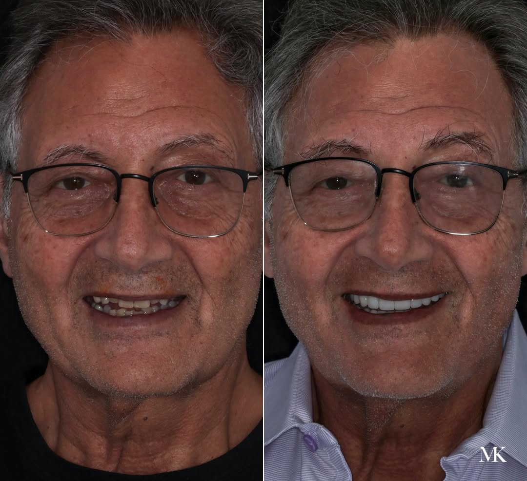 Instagram post by Dr. Michael D. Kosdon: Sometimes the best smile isn’t created with a single procedure. It’s created by knowing when to combine the right ones. For this patient, re…