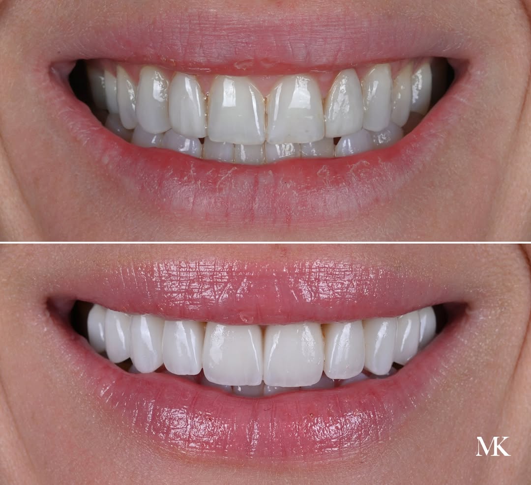 Instagram post by Dr. Michael D. Kosdon: A smile transformation should never look like a completely different person. It should feel like a healthier, more refined version of the sm…