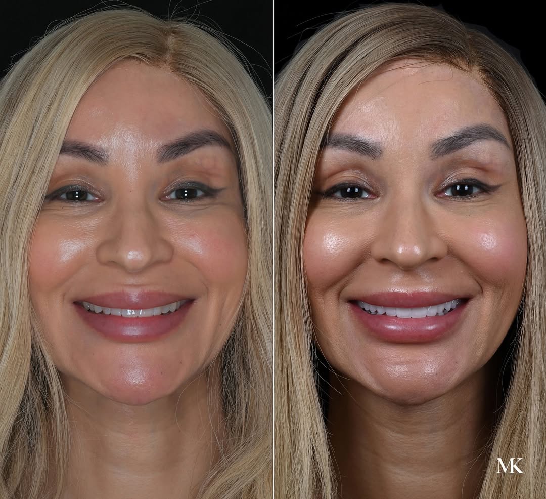 Instagram post by Dr. Michael D. Kosdon: A brighter smile—but still unmistakably hers. This transformation was designed to improve tooth proportion, symmetry, color and overall smil…