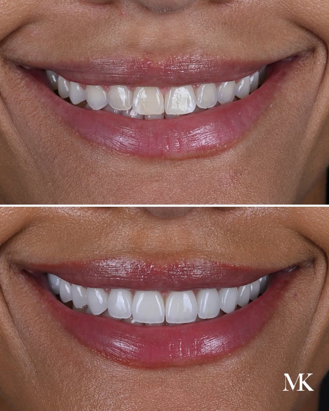Instagram post by Dr. Michael D. Kosdon: 12 upper porcelain veneers, designed to bring the smile into better balance. The goal wasn’t to change her smile—it was to refine it. We imp…