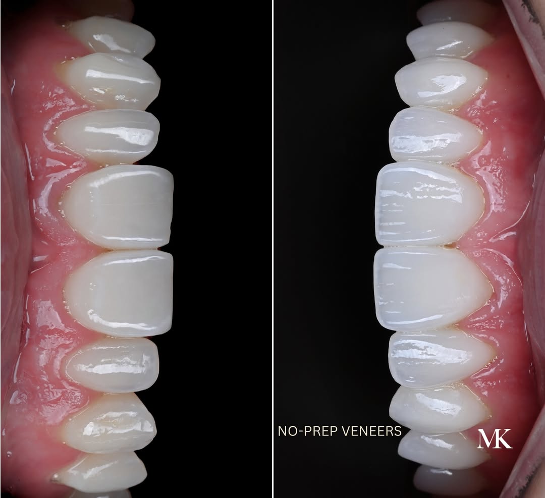 Instagram post by Dr. Michael D. Kosdon: 10 upper no-prep porcelain veneers. ✅ No shots ✅ No drilling ✅ No removal of healthy tooth structure Just carefully designed porcelain added…