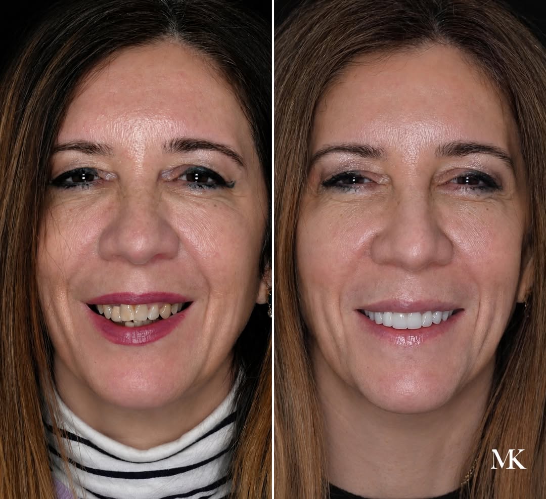 Instagram post by Dr. Michael D. Kosdon: The goal was never to give her a different smile — it was to make her smile feel more balanced, brighter, and beautifully natural. By refini…