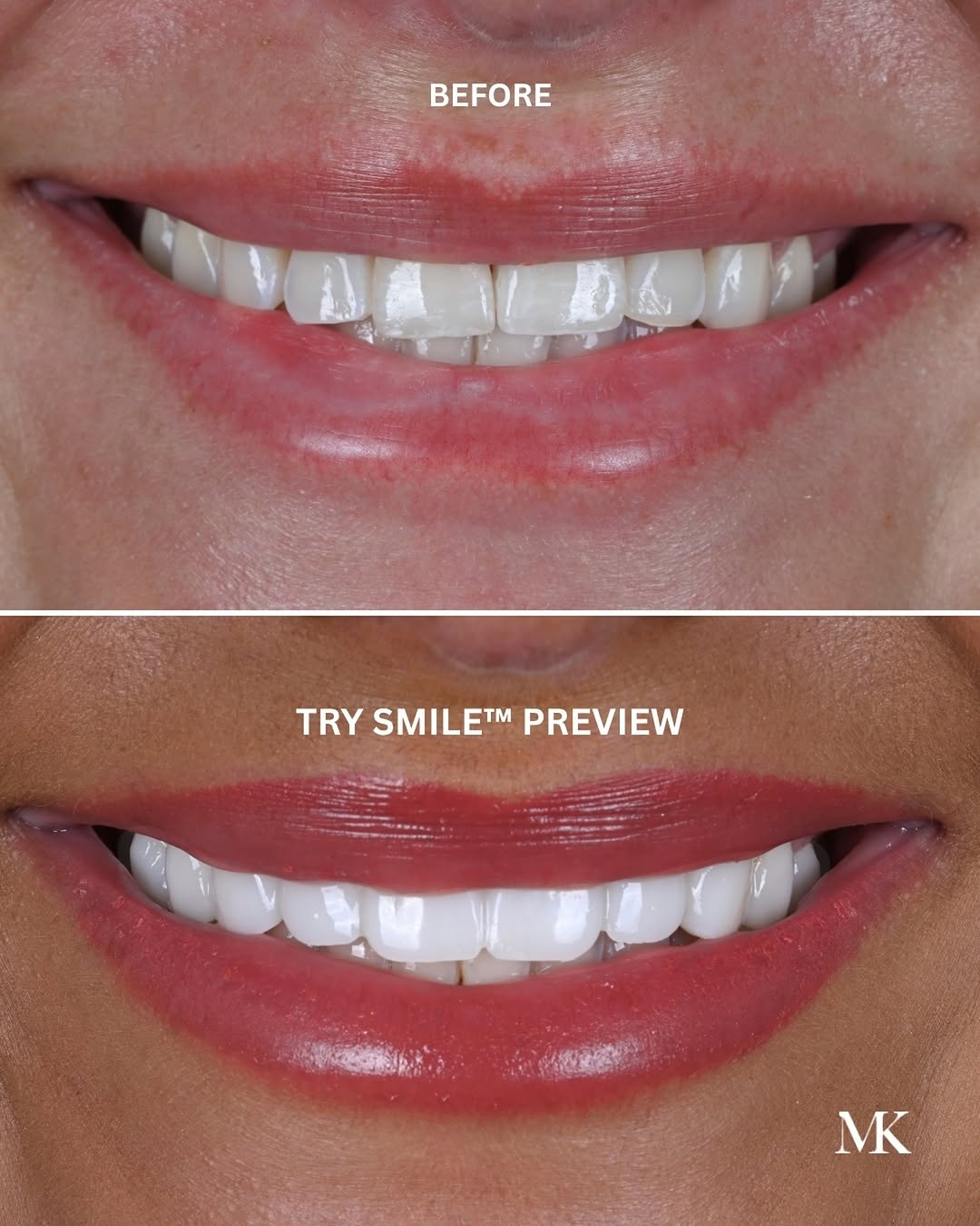 Instagram post by Dr. Michael D. Kosdon: What if you could see your new smile before committing to treatment? This is not the final porcelain. This is her Try Smile™ Preview — a way…