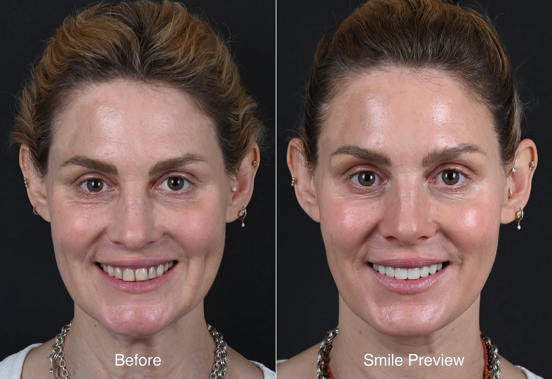 Instagram post by Dr. Michael D. Kosdon: The biggest fear I hear from patients isn’t about getting veneers. It’s about not knowing what they’re going to look like. “Will my teeth lo…
